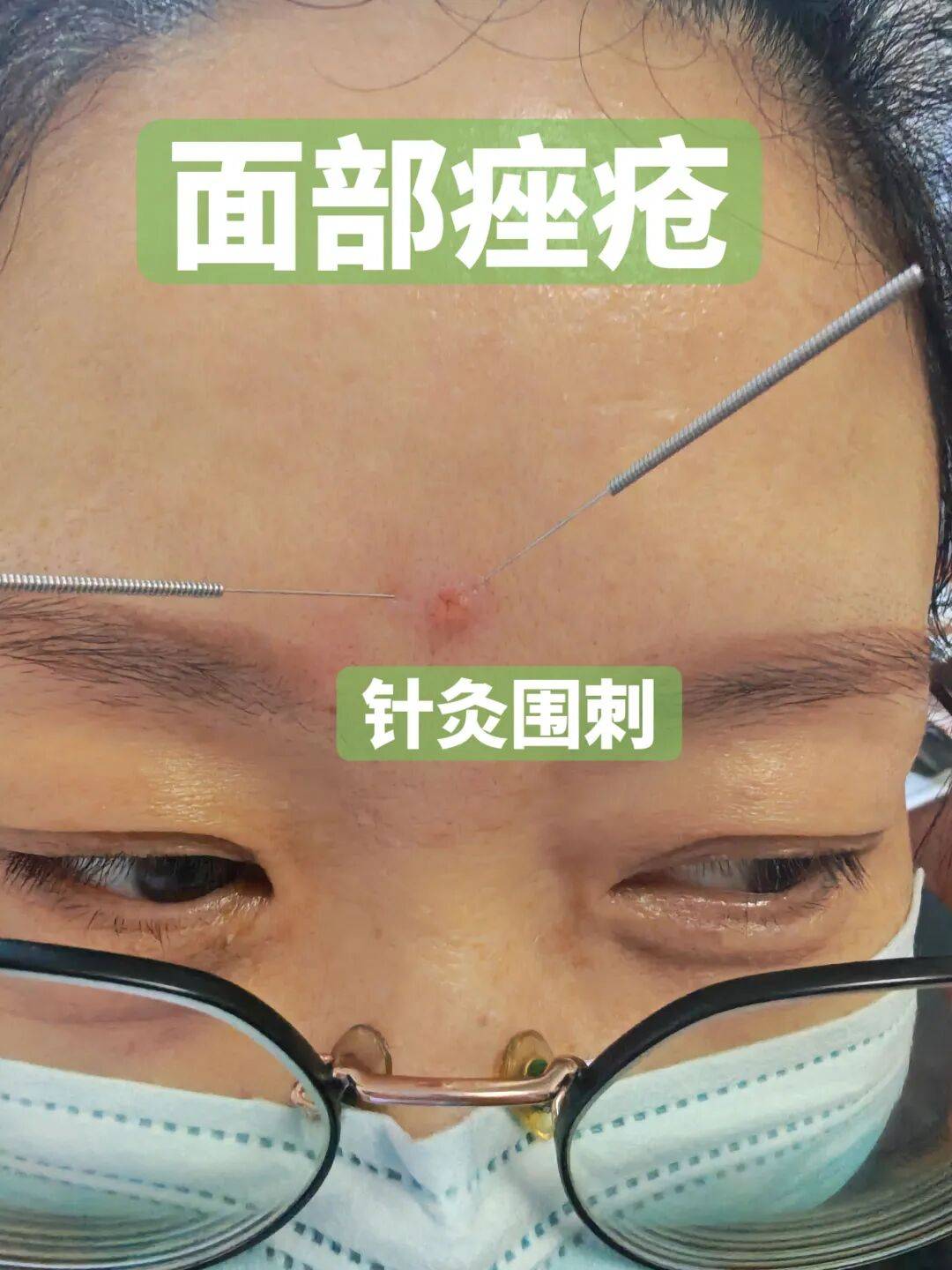 痤瘡“拿捏”