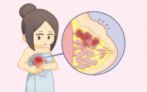 科普 | 乳腺癌的預防——三級預防策略，呵護女性乳腺健康