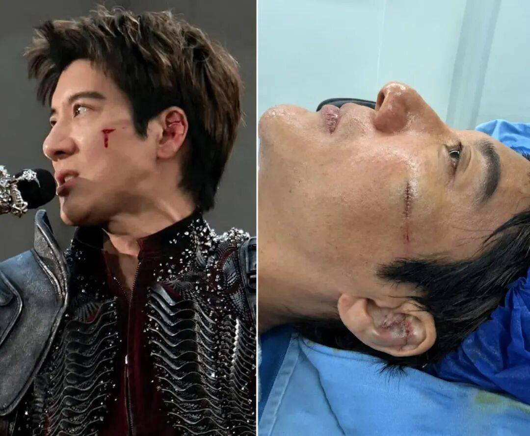 精藝·醫問 | 從王力宏的意外事故，來擺一擺“美容縫合”