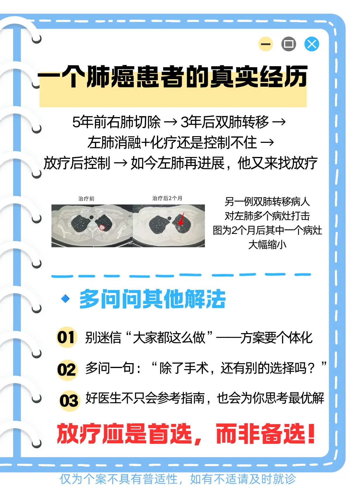 腦膜瘤一定要開顱嗎？放療專家給出三層決策邏輯，建議收藏